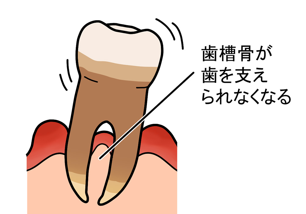 重度の歯周炎