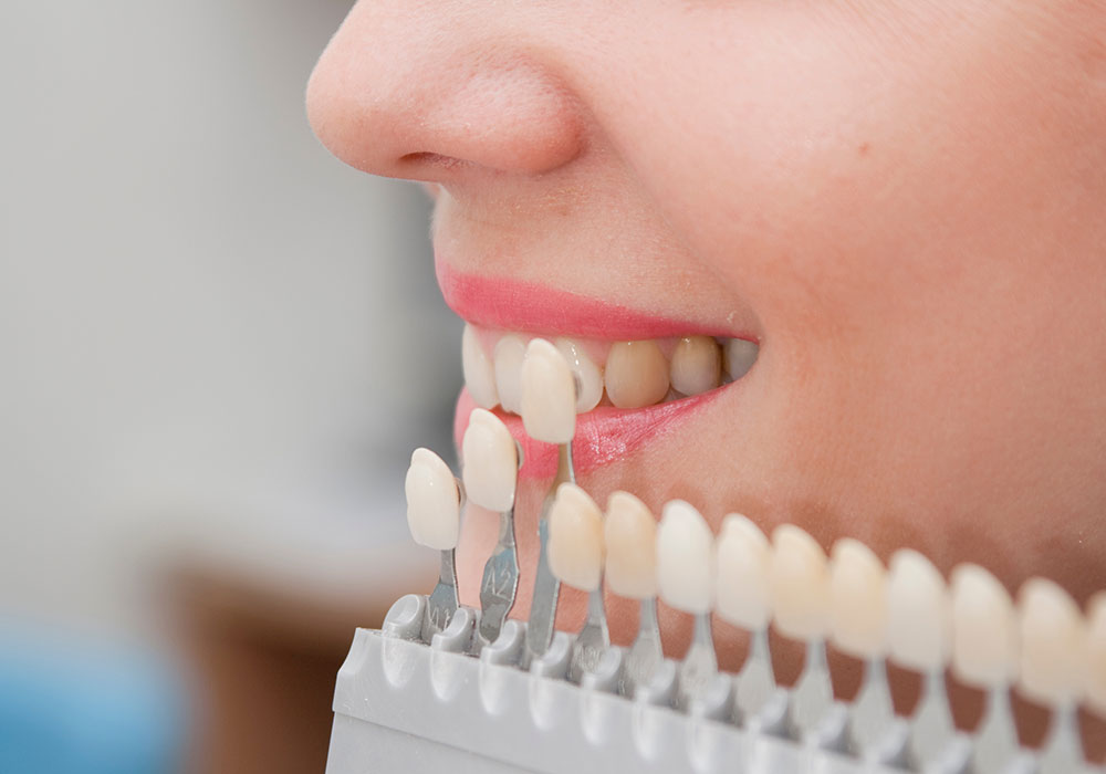 ホワイトニング